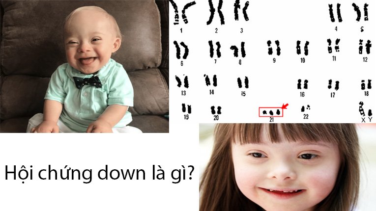 Bệnh Down là một hội chứng do đột biến số lượng nhiễm sắc thể (NST), cụ thể thể là cặp NST số 21 thừa một chiếc gọi là trisomy 21